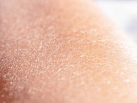 Przyczyny suchej skóry
